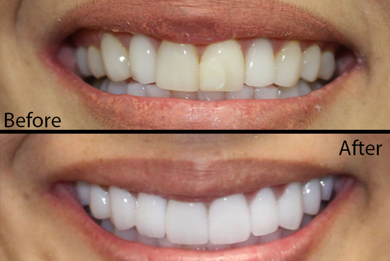 before and after