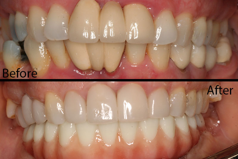before-after
