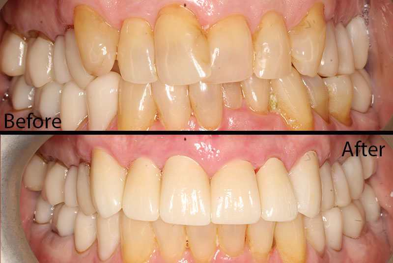 before after