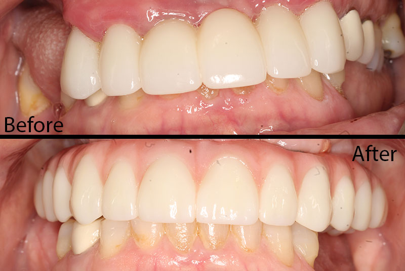 before after