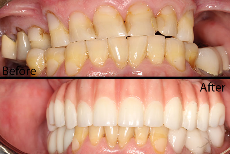 before after