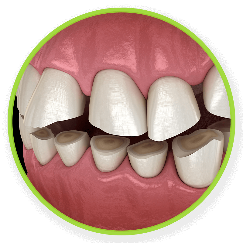 Bruxism