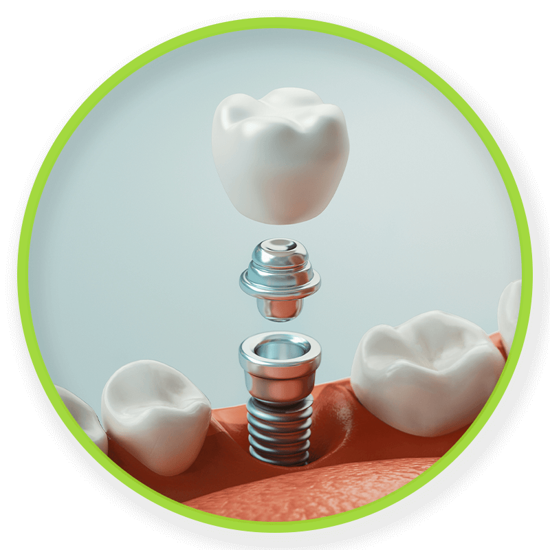 dental implant