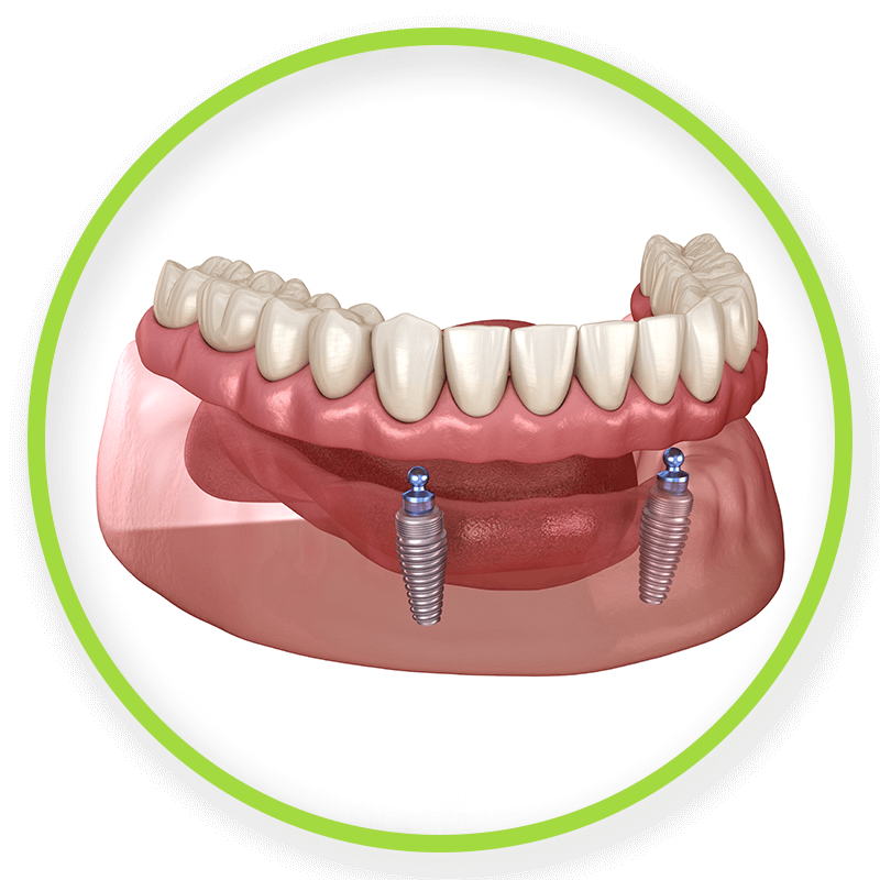 denture supported implants