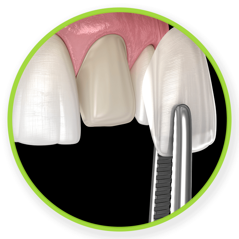 veneers
