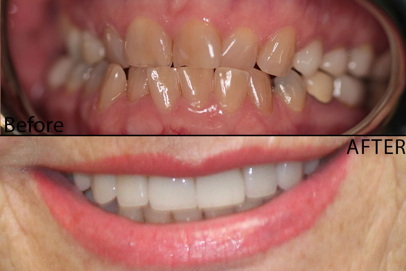 before after