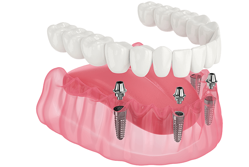 FULL arch implants