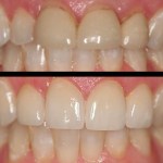Patient's mouth before and after dental treatment