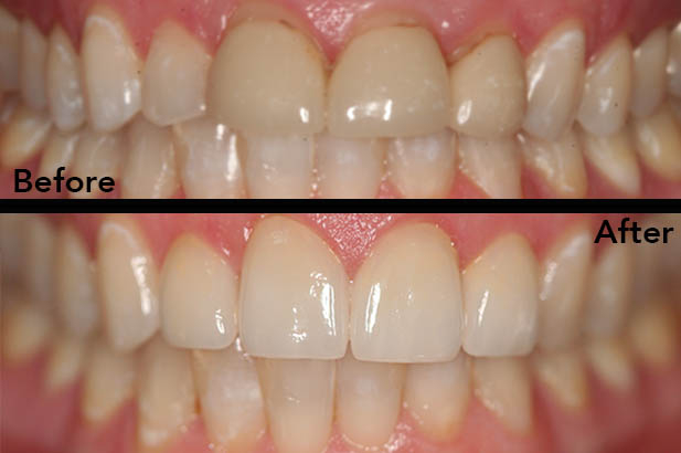 Patient's mouth before and after dental treatment