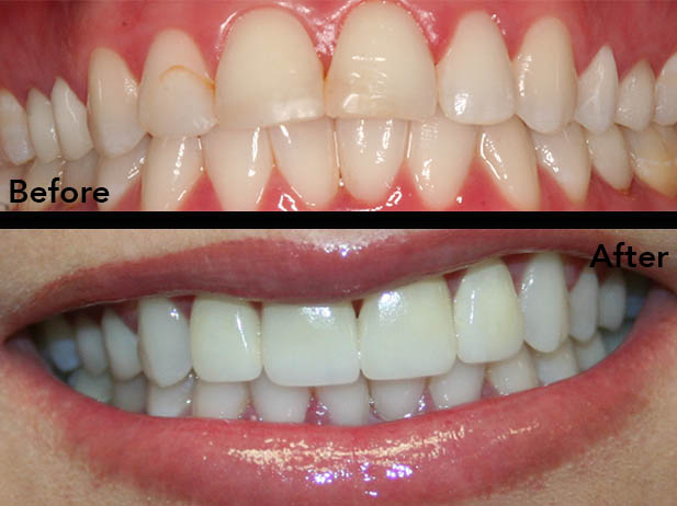 Patient's mouth before and after dental treatment