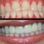 Patient's mouth before and after dental treatment