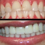 Patient's mouth before and after dental treatment