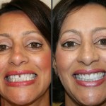 Patient smiling before and after dental treatment