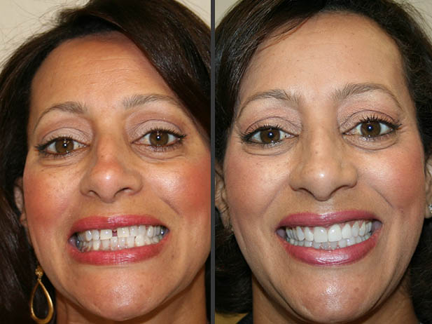 Patient smiling before and after dental treatment