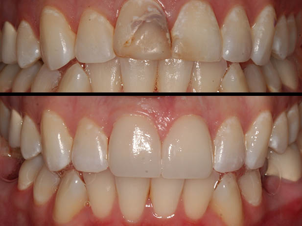 Patient's mouth before and after dental treatment