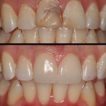 Patient's mouth before and after dental treatment
