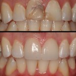 Patient's mouth before and after dental treatment