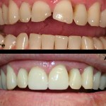 Patient's mouth before and after dental treatment